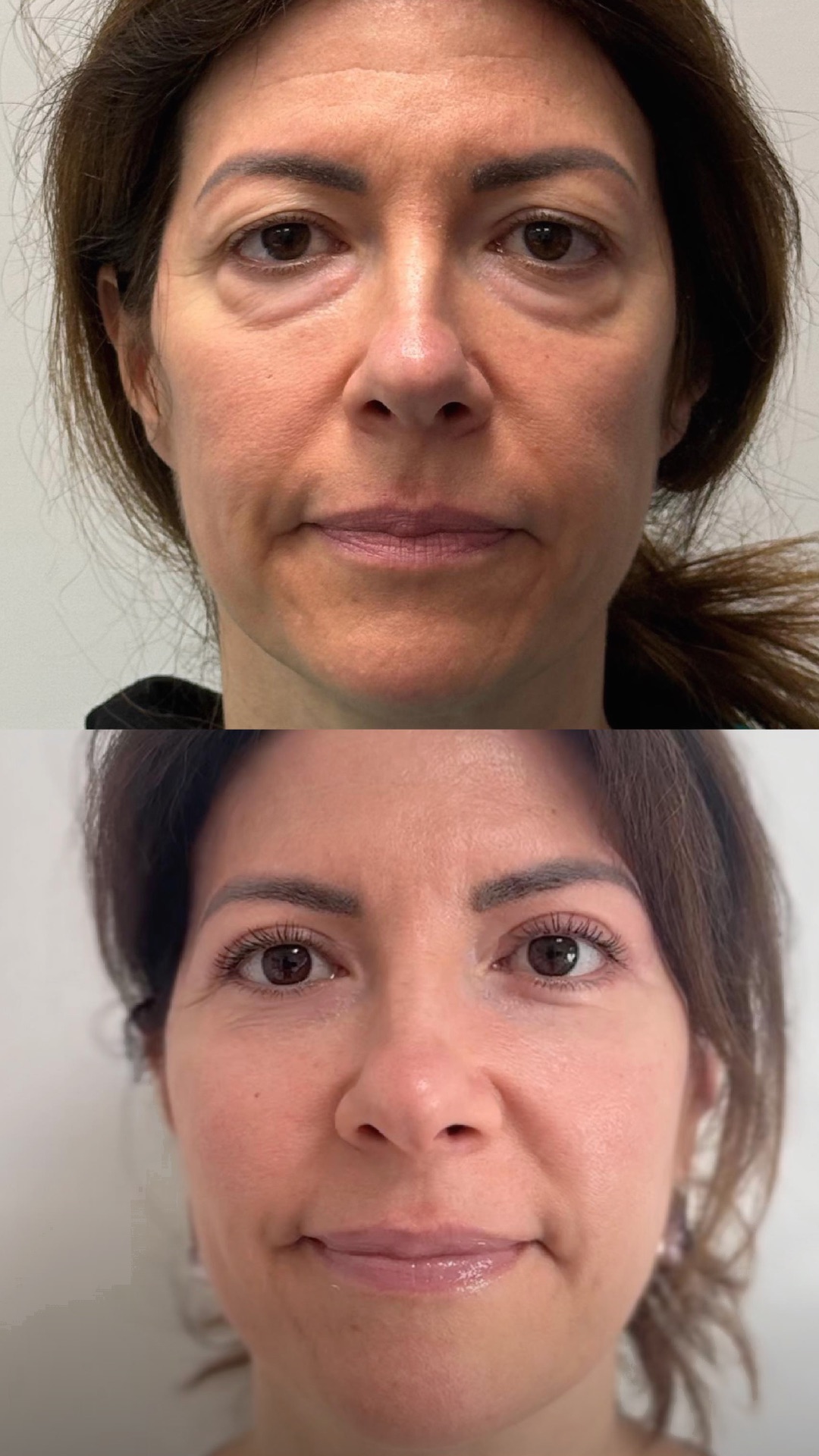 Blefaroplastica e Lipofilling prima e dopo