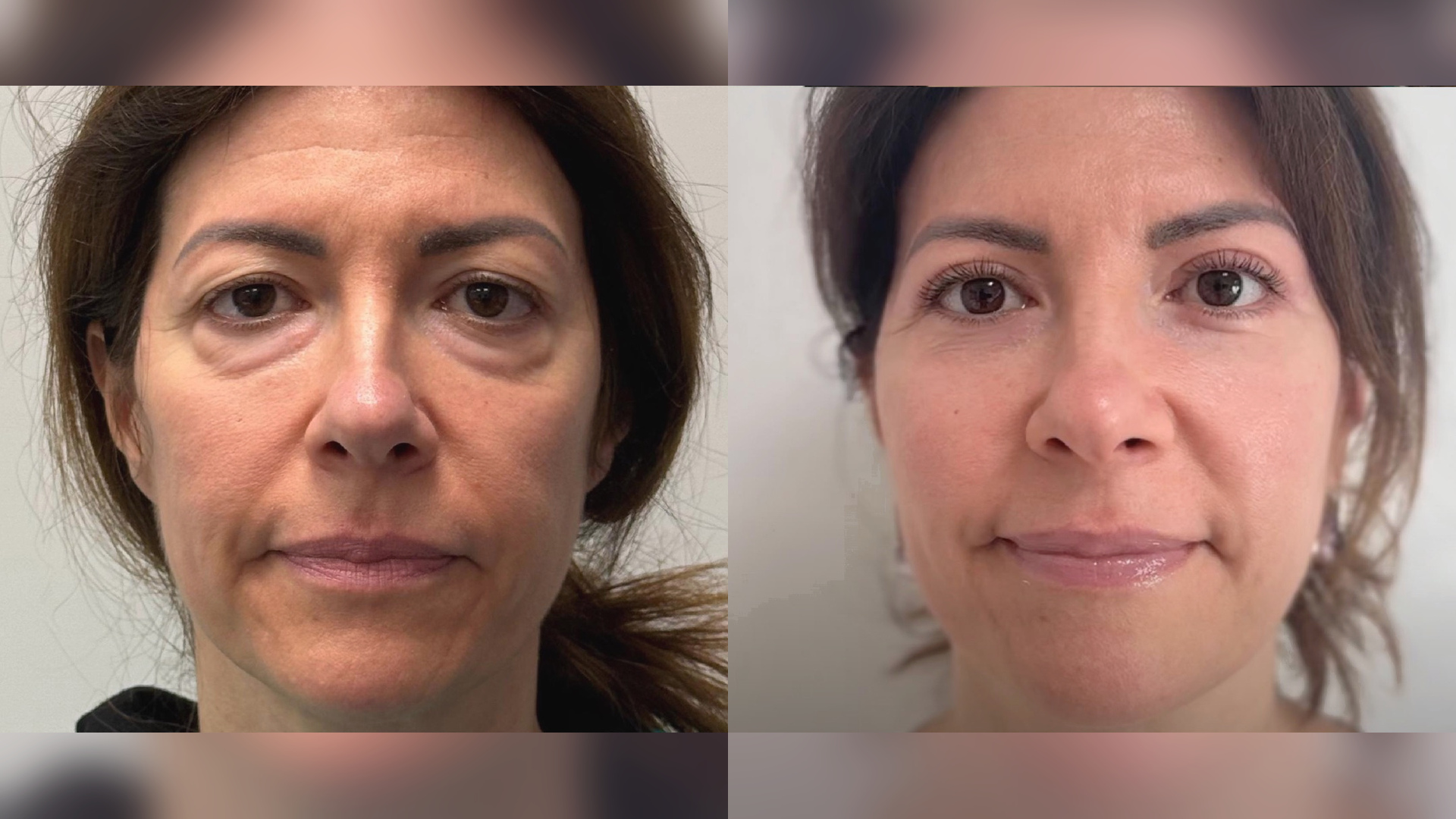 Blefaroplastica_Lipofilling_before_after_16x9_lilla_no_bianco
