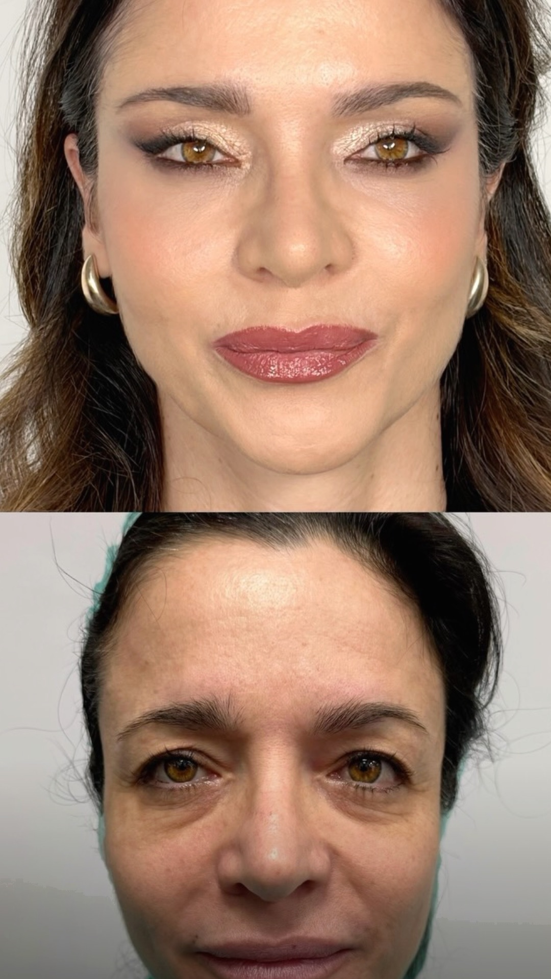 Lifting temporo malare con Blefaroplastica superiore e inferiore transcongiuntivale con Mini pinch e Lipofilling
