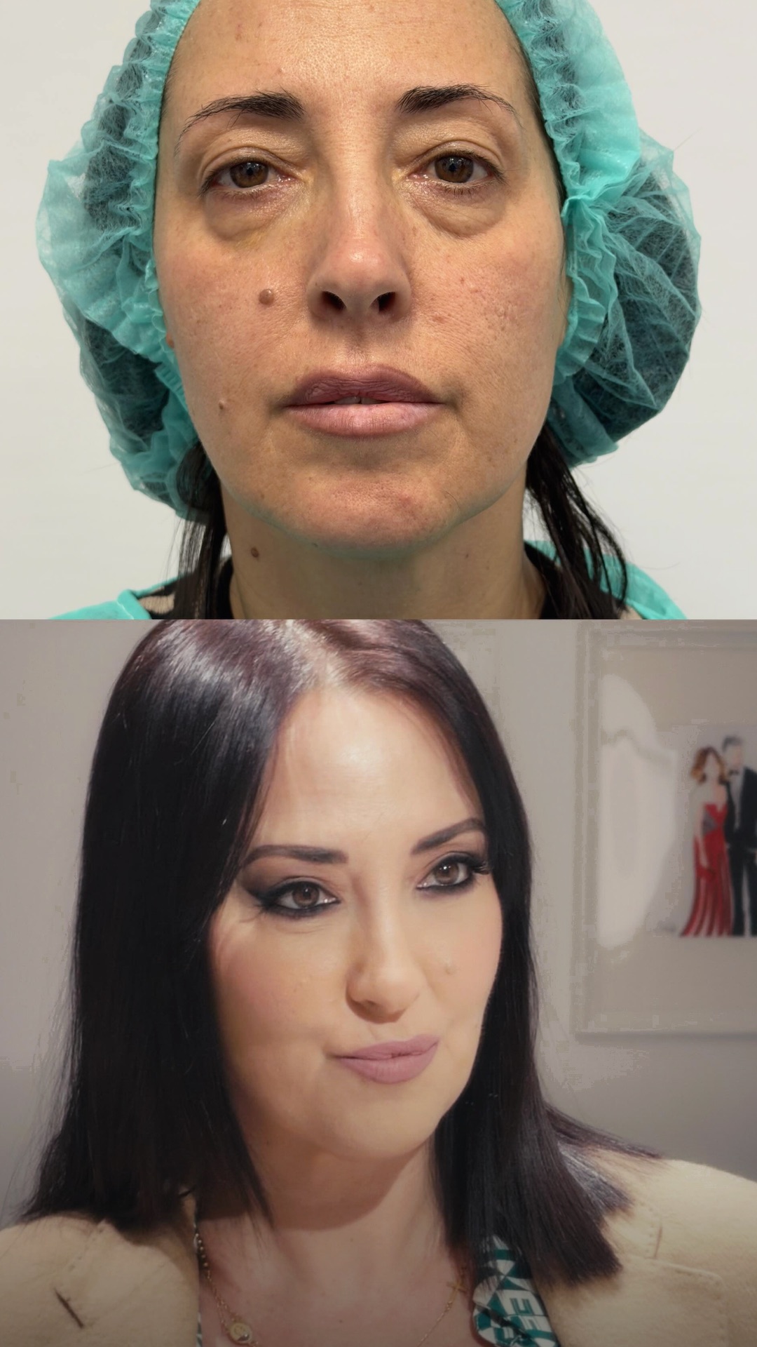 prima e dopo blefaroplastica completa eseguito dalla dottoressa giulia filippello